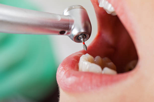 Best Emergency Treatment for Toothache in Yreka, CA